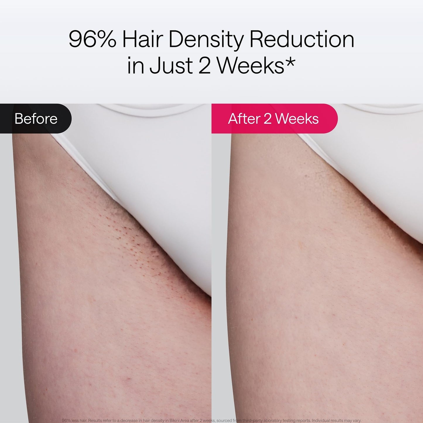 Air 10 IPL Hair Removal Device with Ice Cooling Technology – Permanent, Painless At-Home Treatments for Women and Men